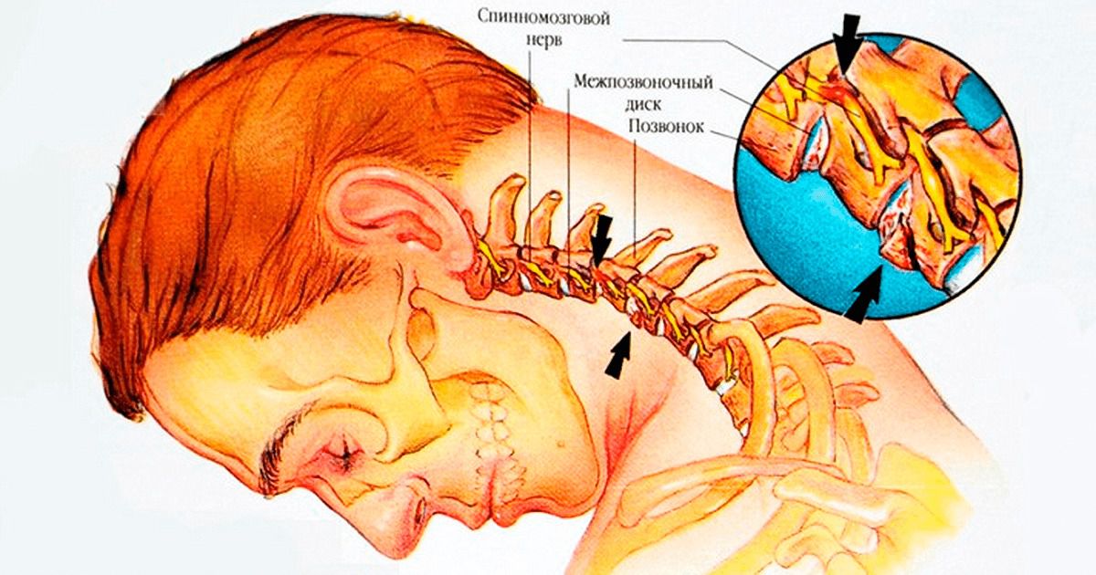 Шийний остеохондроз: Причини, симптоми, сучасні методи лікування та ефективна профілактика