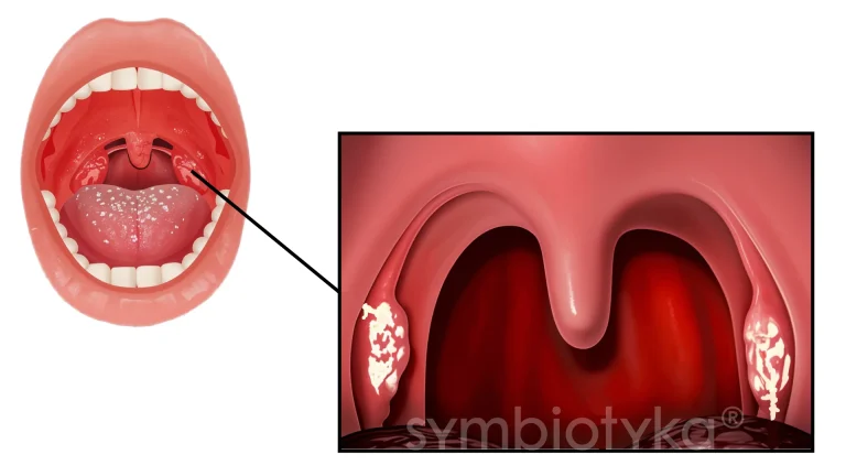 685962d4fabfa4af0f30e6fd_Гострий тонзиліт (ангіна)